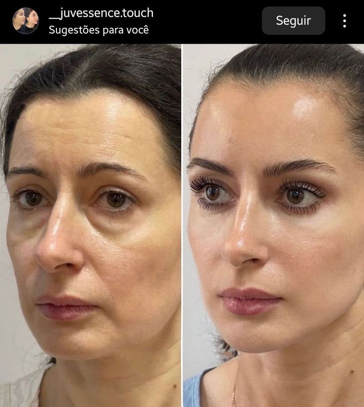 Client transformation — Renewed Glow